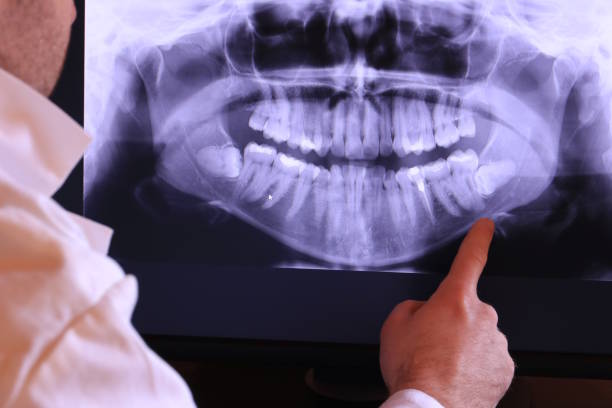 Best Emergency Dental Care for Broken or Chipped Teeth in Spencerport, NY