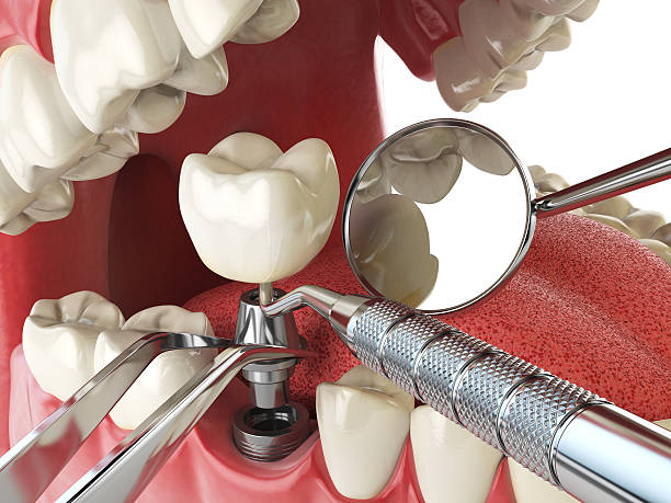 Best Emergency Treatment for Dental Infections or Abscesses in Spencerport, NY